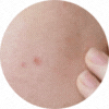 Reduces Acne & Pimples
