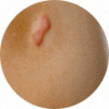 Fades Blemishes & Scars